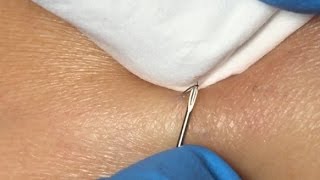 Ingrown Hairs Extraction  16 minutes [upl. by Eelak]