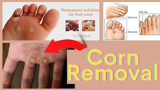 Corn Removal Treatment on the Hand amp foot  Corn Removal by Laser [upl. by Andriette]