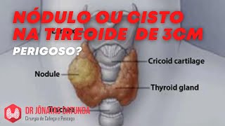 7 SINAIS PERIGOSOS de um NÓDULO na TIREOIDE Sintomas de Câncer na Tireoide [upl. by Anahoj]