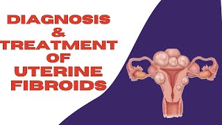 What Are The Treatments For Uterine Fibroids  How To Get Rid of Fibroids [upl. by Kamin]