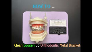 How to Clean up an Orthodontic Bracket When its Loosen  如何清潔鬆動的矯正金屬托槽 [upl. by Mcgregor]