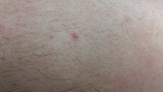 Encapsulated Ingrown Hairs [upl. by Aikemit]