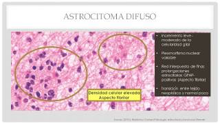 Astrocitomas Patología Morfológica y Funcional IV [upl. by Barvick370]