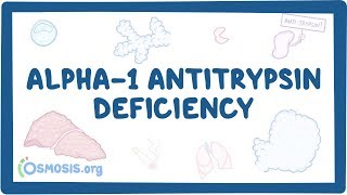 Alpha1 Antitrypsin Deficiency  causes symptoms diagnosis treatment pathology [upl. by Laurianne]