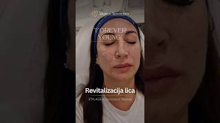 Lifting lica hijaluronskim filerima Forever young Medica Aesthetica skincare filler facelift [upl. by Zoha]