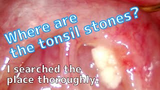 Where are the Tonsil stones hiding 【I searched thoroughly】 [upl. by Standish47]