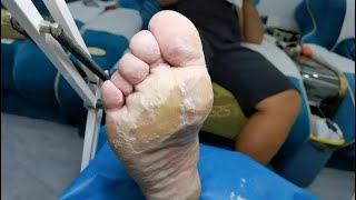 Look at the feet Dead skin removal from sole of feet and massive dead skin was peeled off [upl. by Ellan287]