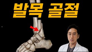 발목 골절의 치료  trimalleolar bimalleolar ankle ORIF [upl. by Gneh965]