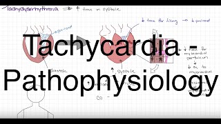 Pathophysiology of Tachydysrhythmia [upl. by Sehcaep]