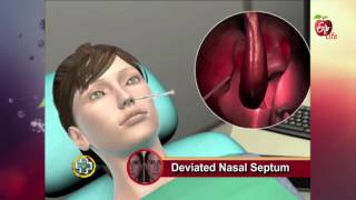 Aarogyamastu  Deviated Nasal Septum  23rd May 2017  ఆరోగ్యమస్తు [upl. by Ajani900]