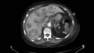 Metastatic pancreatic cancer with PVT PE and DVT [upl. by Wescott]