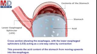 All About Reflux Esophagitis [upl. by Yllil]