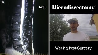 Microdiscectomy 2 Week Post Surgery L5S1 [upl. by Clayton308]