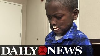 Congolese Boy to Undergo Face Surgery After Chimp Attack [upl. by Dorwin]