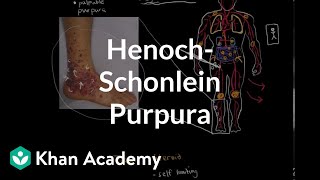 HenochSchonlein purpura  Circulatory System and Disease  NCLEXRN  Khan Academy [upl. by Ephrayim]