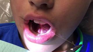 Functional frenuloplasty updated technique with lingual palatal suction [upl. by Eiramenna]