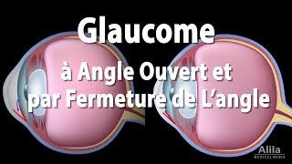 Pathologie du Glaucome Animation [upl. by Odarbil]