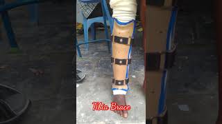 Tibia Brace [upl. by Aroon]