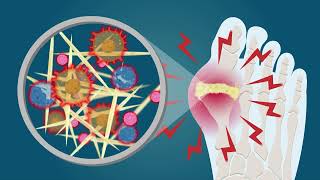 Gout Pathophysiology Causes Symptoms Risk Factors Diagnosis and Treatments Animation [upl. by Yaeger]