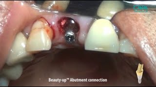 BGBRBMP Guided Bone Regeneration with Beautyup Abutment amp Natural Tooth [upl. by Rehoptsirhc]