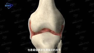 3D Knee synovitis膝关节滑膜炎 [upl. by Orvah]