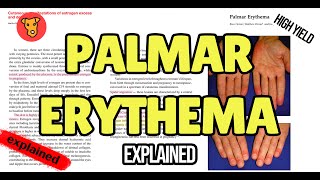 PALMAR ERYTHEMA Pathogenesis of Signs and Symptoms [upl. by Megen]