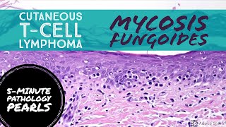 Mycosis Fungoides Cutaneous TCell Lymphoma 5Minute Pathology Pearls [upl. by Ahsyt28]