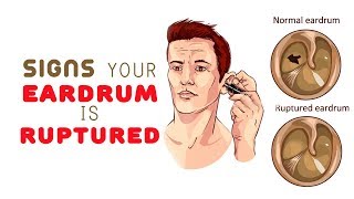 8 Signs Your Eardrum is Ruptured [upl. by Aubarta]