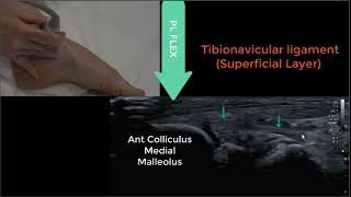 Deltoid Ligament Ultrasound 2023 [upl. by Llerraf]