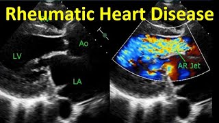 Rheumatic Heart Disease [upl. by Suoicul979]