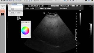 Fixing ID with Osirix [upl. by Nilauqcaj]