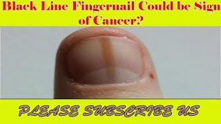 Black Line Fingernail Could be Sign of Cancer V 4 YOU [upl. by Pettit499]