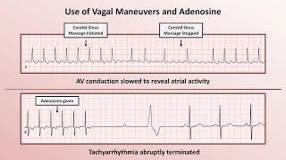 Intro to EKG Interpretation  How to Identify Any Tachyarrhythmia with 6 Easy Questions [upl. by Wolfram]