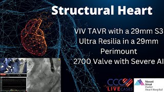 VIV TAVR with a 29mm S3 Ultra Resilia in a 29mm Perimount2700 Valve with Severe AI [upl. by Kamilah692]