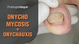 Onychomycosis  Onychauxis podology asmr [upl. by Noxin]