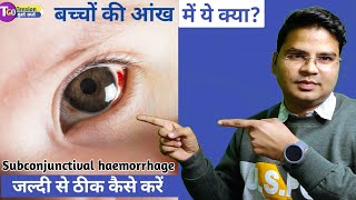 Best eyedrop for red eyes  subconjunctival Hemorrhage  eye care tips [upl. by Etteneg]