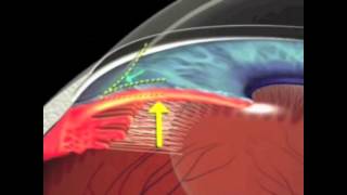 Glaucoma de ángulo cerradoCPO [upl. by Brookner610]