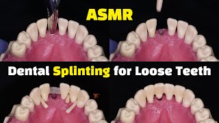 Dental Splinting for Loose Teeth using Ribbond after a Tooth Extraction [upl. by Eetnom471]