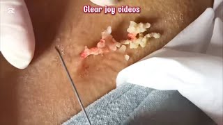 Big Cystic Acne Blackheads Extraction Blackheads amp Milia Whiteheads Removal Pimple Popping [upl. by Akinahc]