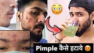 अपना Face ख़राब मत करो  Pimple Acne  How to Remove Pimple  Pimple reasons pimple shorts [upl. by Clellan775]