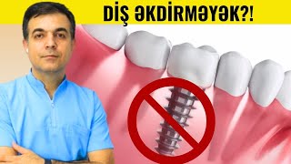 Dental İMPLANTI Nə ilə əvəz etmək olar [upl. by Schick]