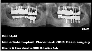 333443 Immediate Implant Placement GBR Basic Surgery [upl. by Ensoll447]