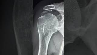 Classic case  Rotator cuff Calcific tendinopathy on plain radiograph radiology calcifictendinosis [upl. by Tessie266]