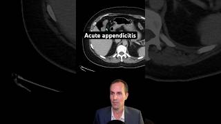 Abdominal CT Tutorials  Acute appendicitis [upl. by Lemmueu791]