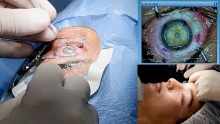 MY LASIK EYE SURGERY  Nederlands [upl. by Joshuah]