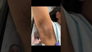 Laser Hair Removal Burn in Dark Skin woman [upl. by Dirgis]