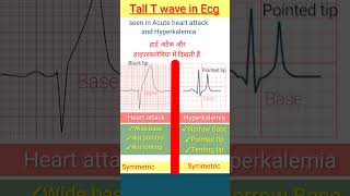 Tall T wave in ecg in heart attack and hyperkalemia lecg shorts [upl. by Alolomo]