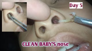 CLEAN BABYS nose day 5 [upl. by Niwrud57]