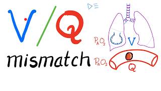 Ventilation Perfusion Ratio VQ and VQ Mismatch  Respiratory Physiology amp Pulmonology [upl. by Anitnegra]