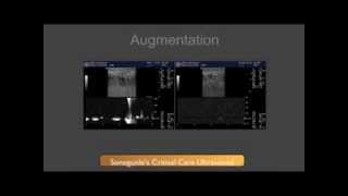 DVT Ultrasound Augmentation Technique [upl. by Ayerhs]